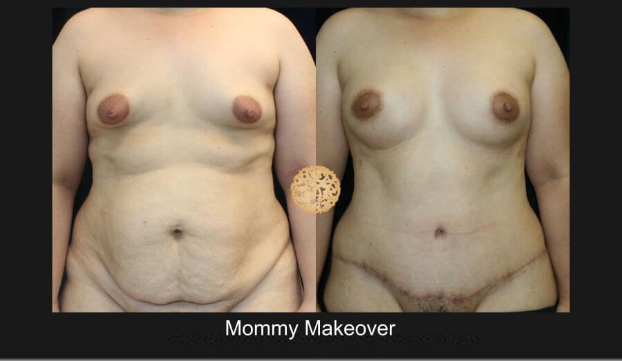 Mommy Makeover Before & After
