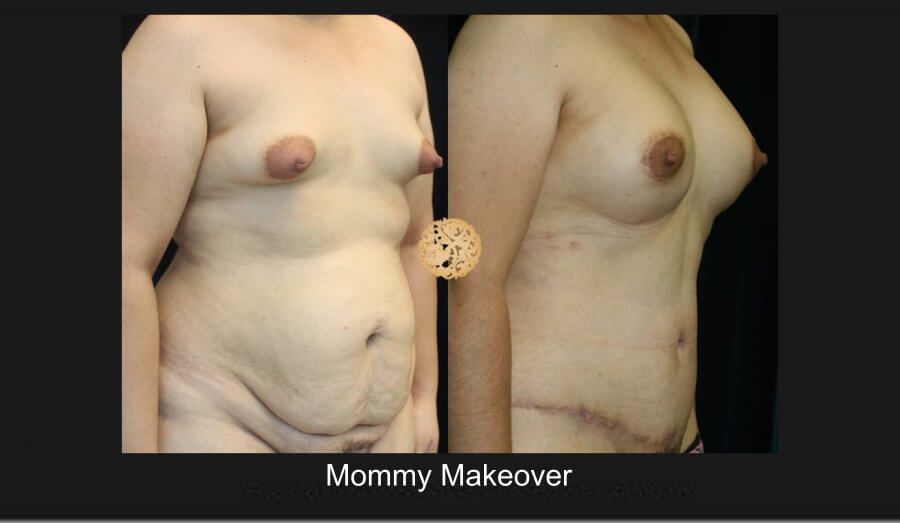Mommy Makeover Before & After
