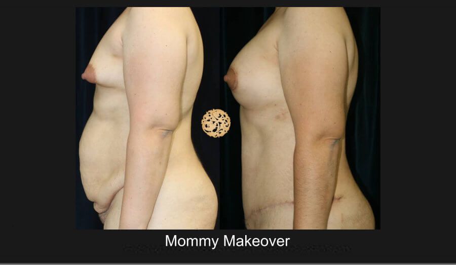 Mommy Makeover Before & After