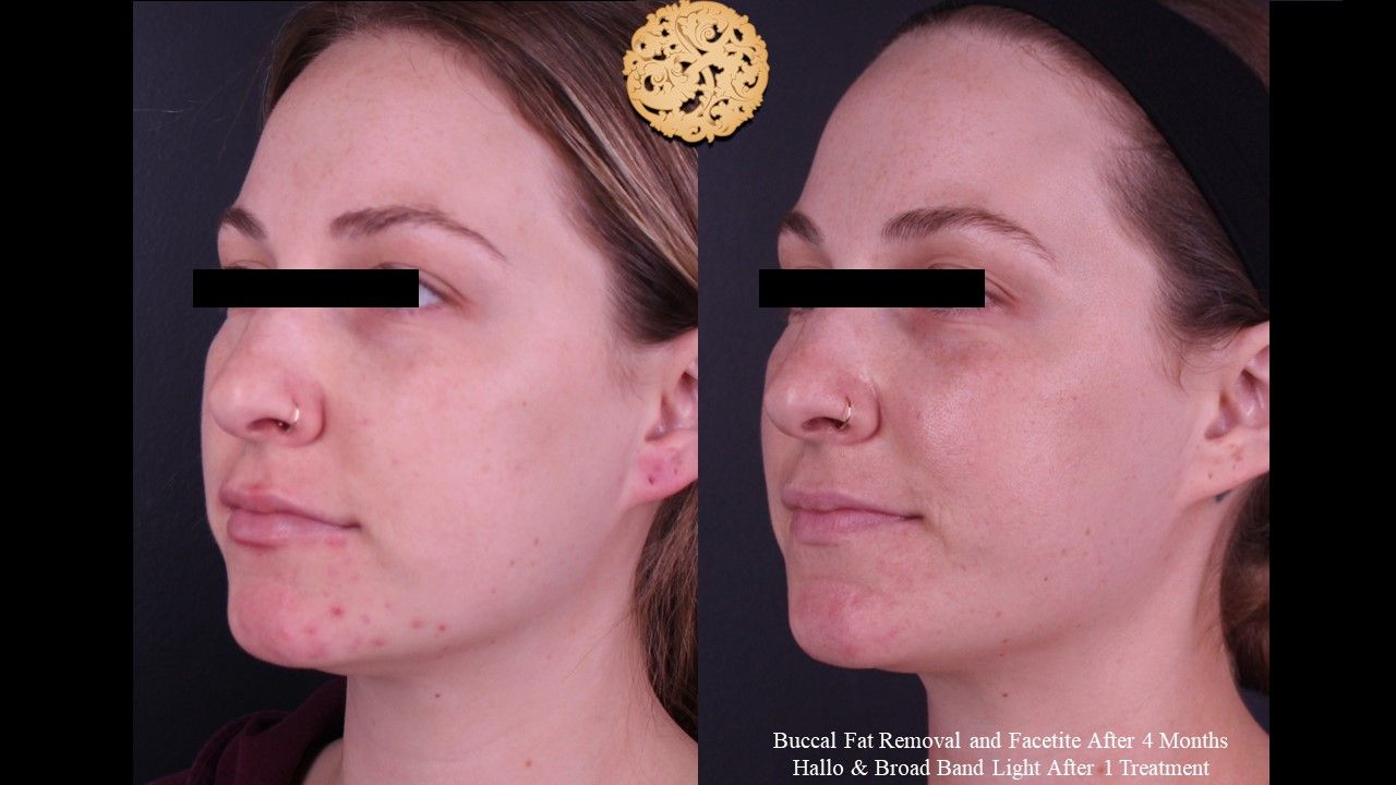 BBL Laser Acne Before & After