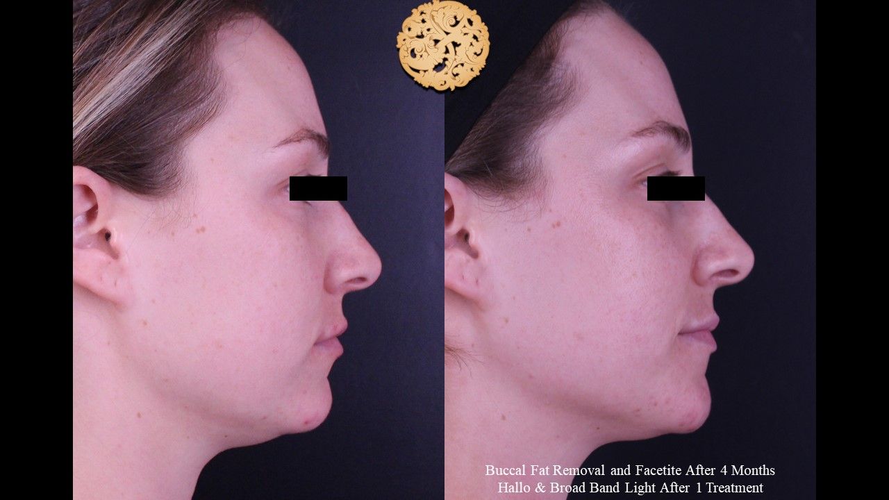 Bbl Laser Acne Before & After