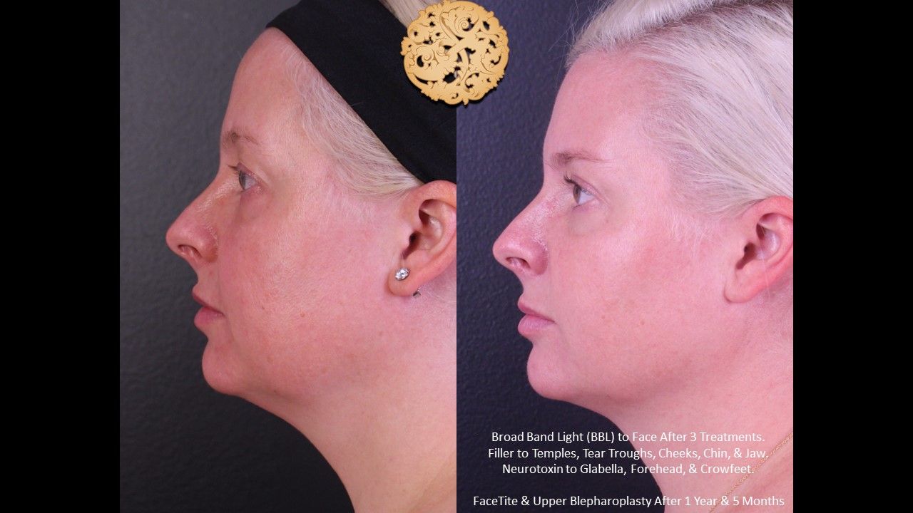 BBL Laser Acne Before & After