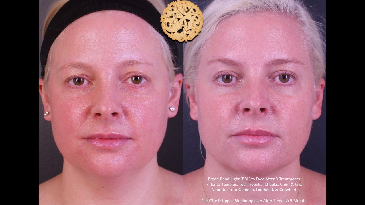 Bbl Laser Acne Before & After