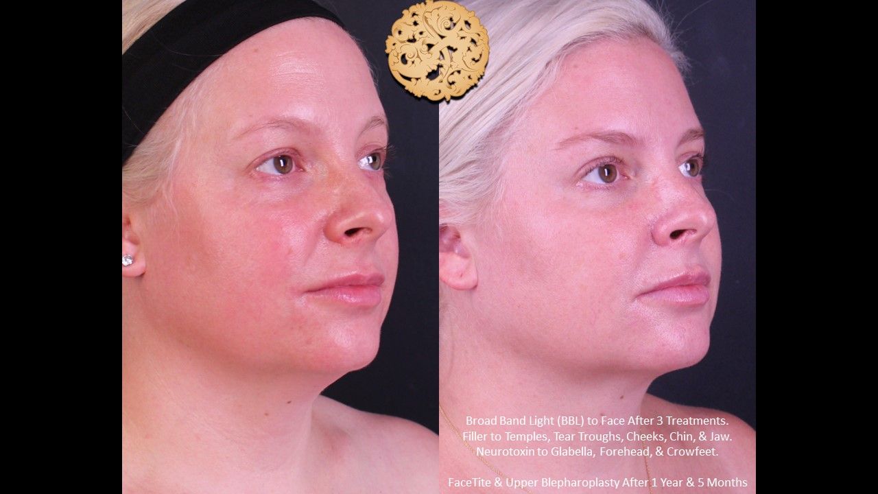 Bbl Laser Acne Before & After