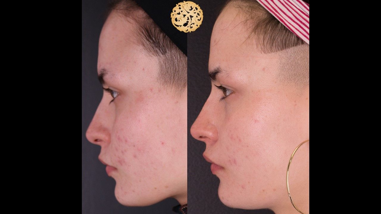 BBL Laser Acne Before & After