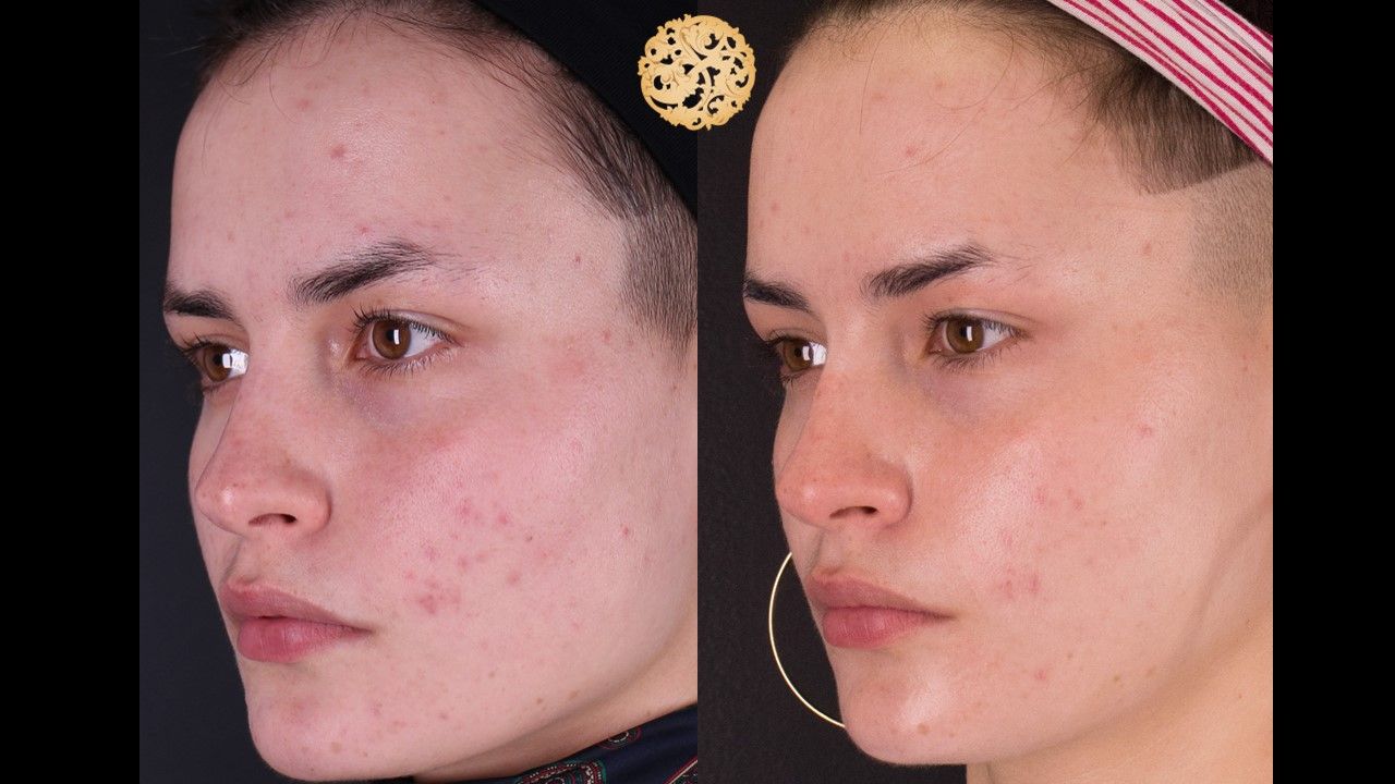 BBL Laser Acne Before & After