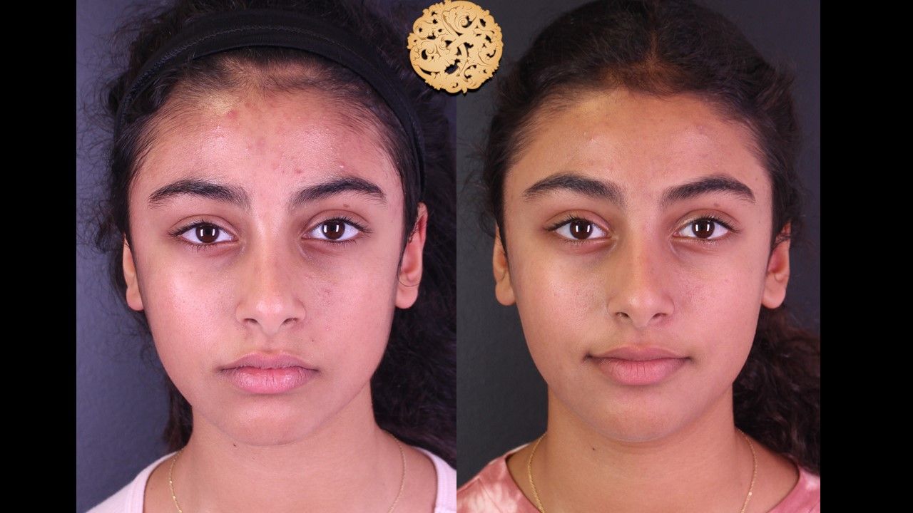 Bbl Laser Acne Before & After