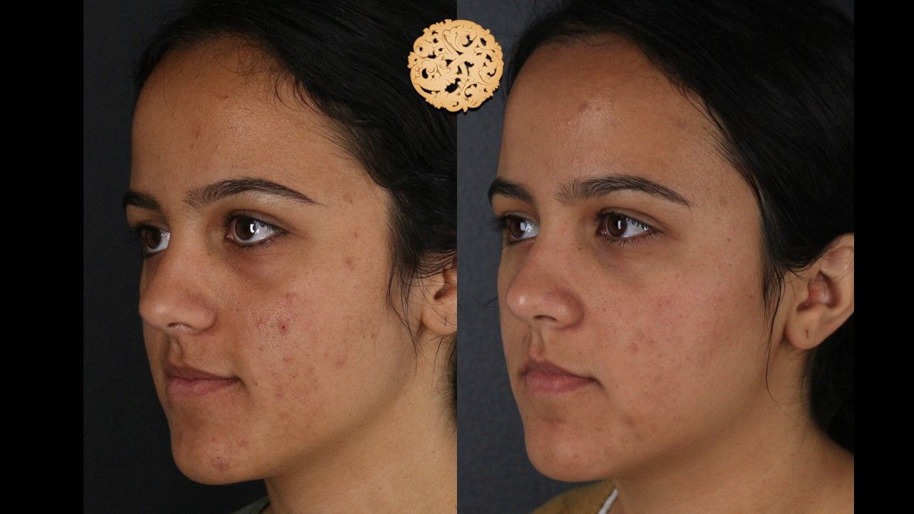 BBL Laser Acne Before & After