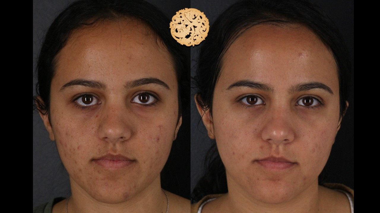 Bbl Laser Acne Before & After