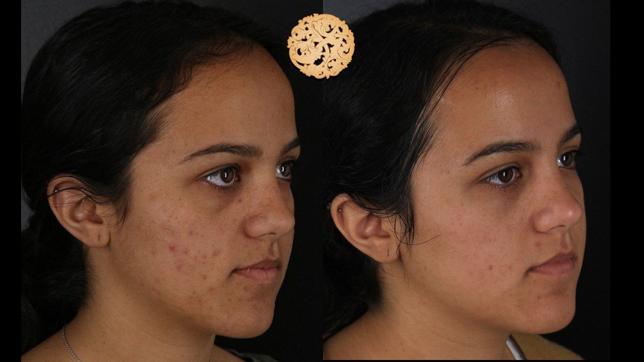 Bbl Laser Acne Before & After
