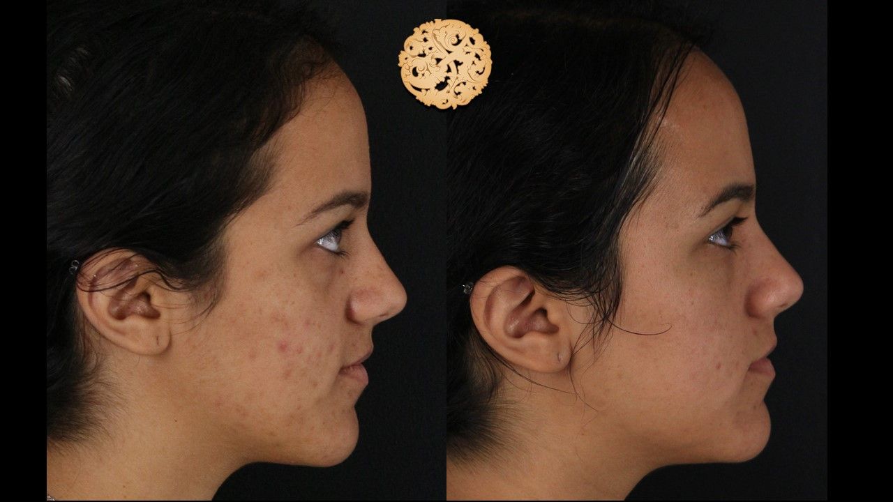 Bbl Laser Acne Before & After