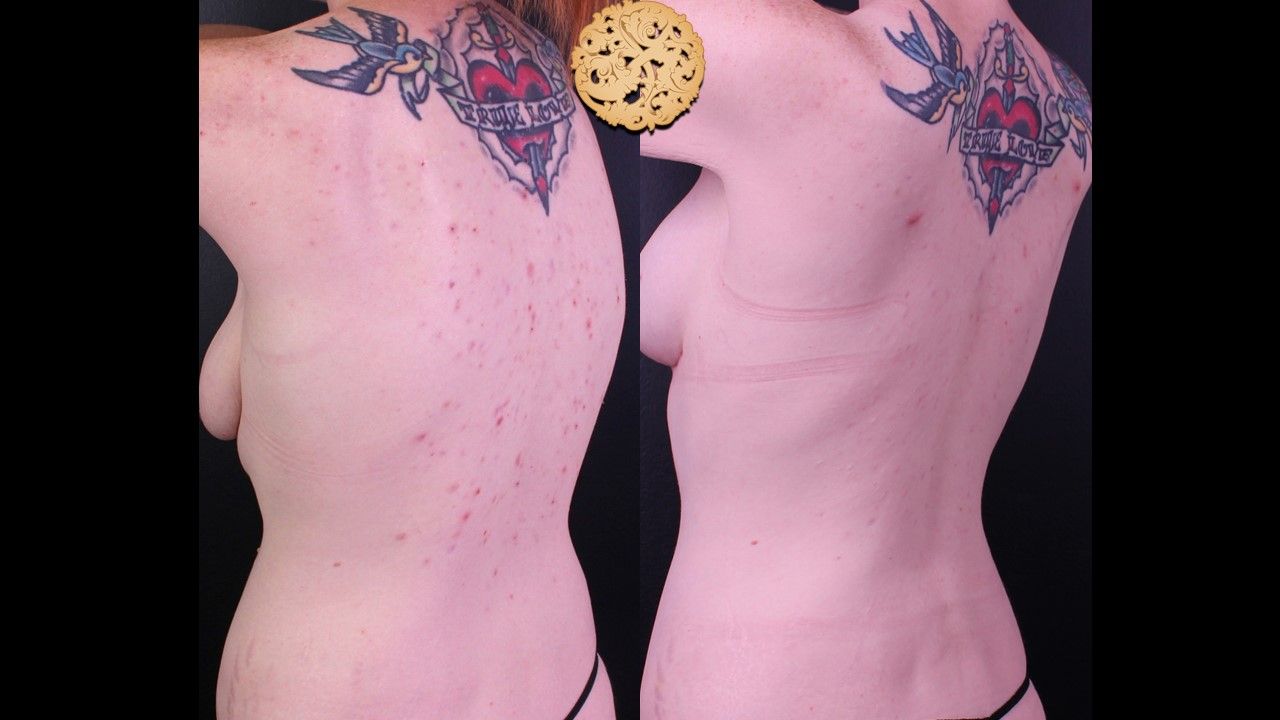 BBL Laser Acne Before & After