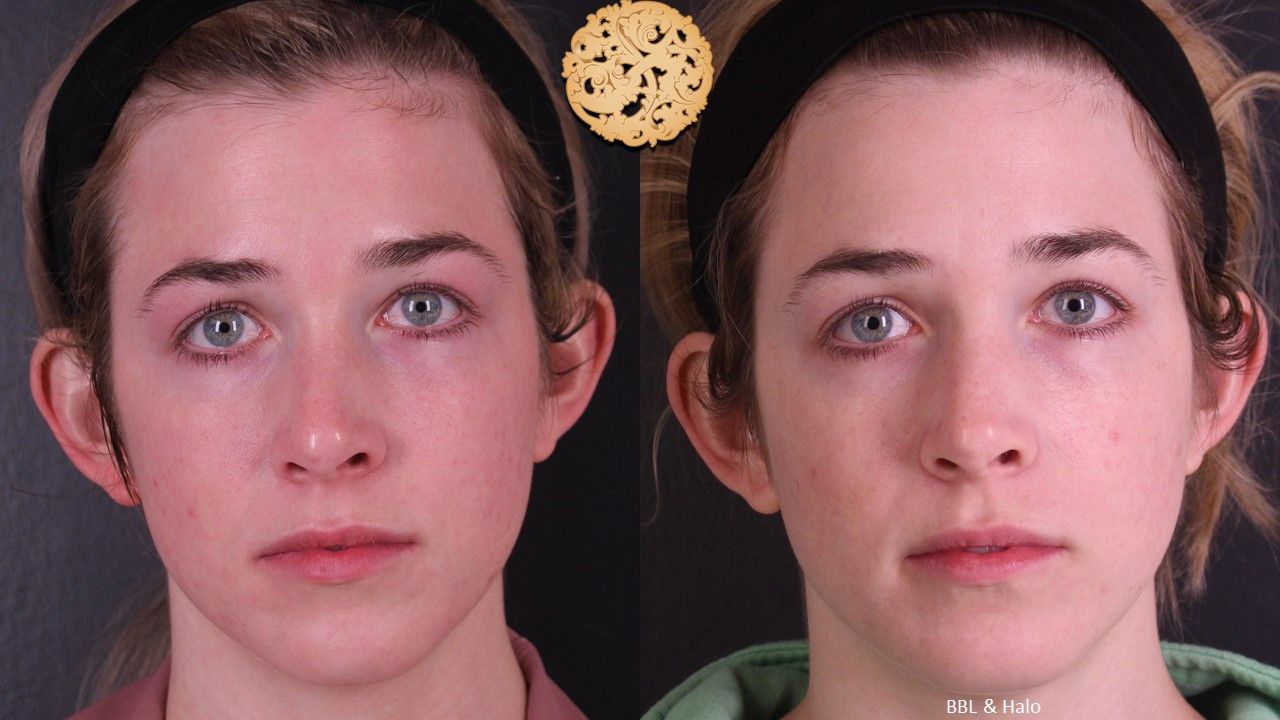 Bbl Laser Acne Before & After