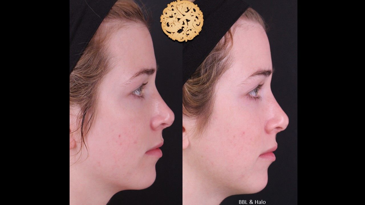 Bbl Laser Acne Before & After