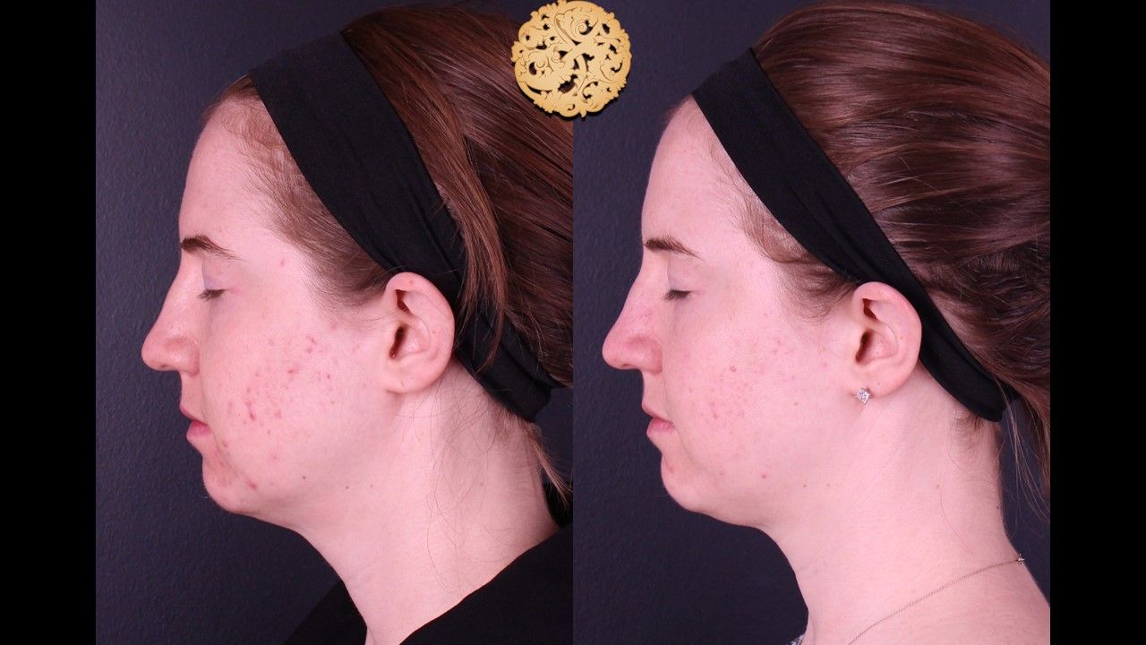 BBL Laser Acne Before & After
