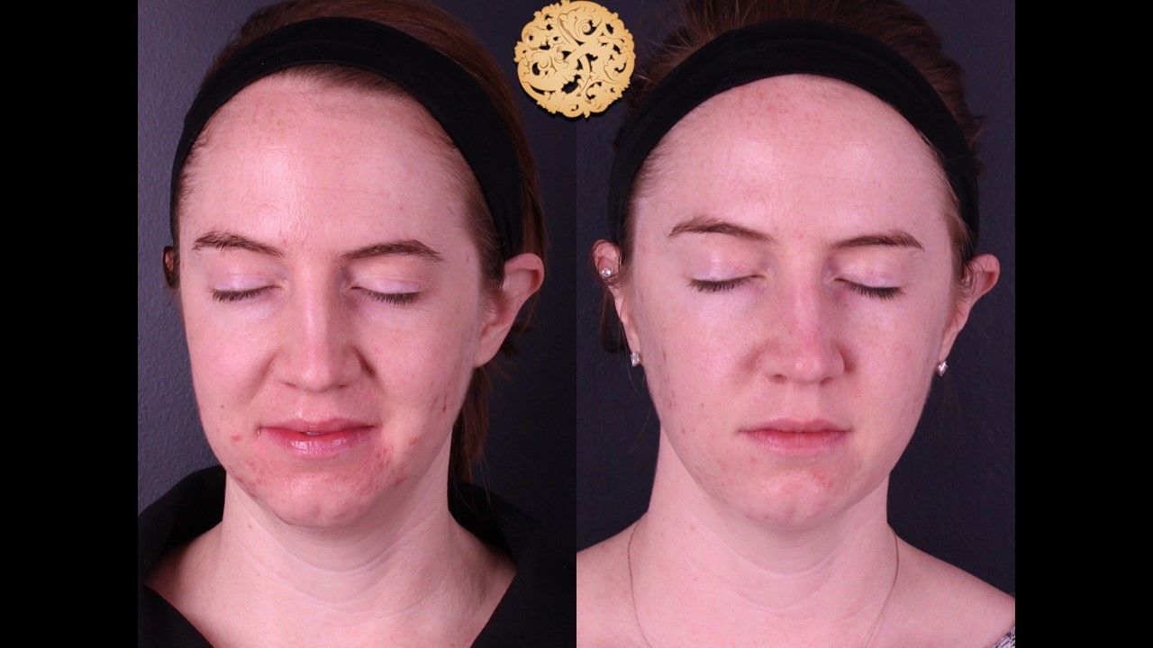 Bbl Laser Acne Before & After
