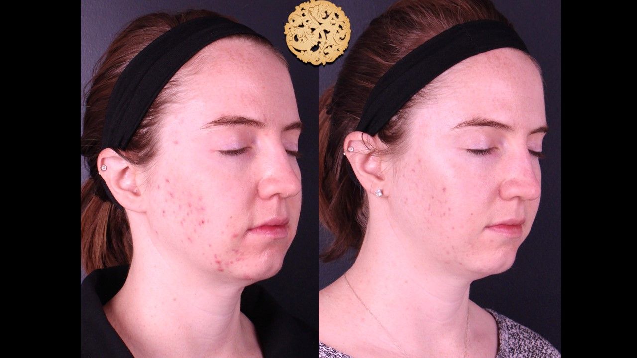 Bbl Laser Acne Before & After