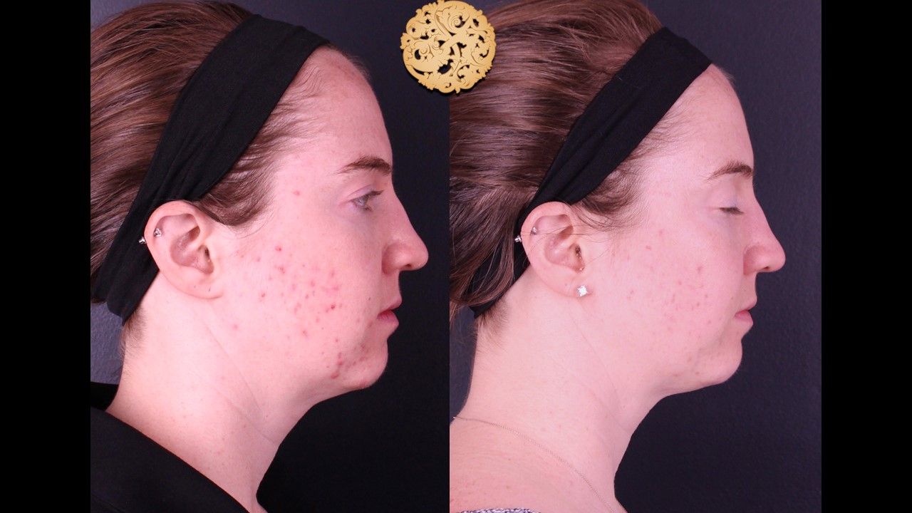 Bbl Laser Acne Before & After