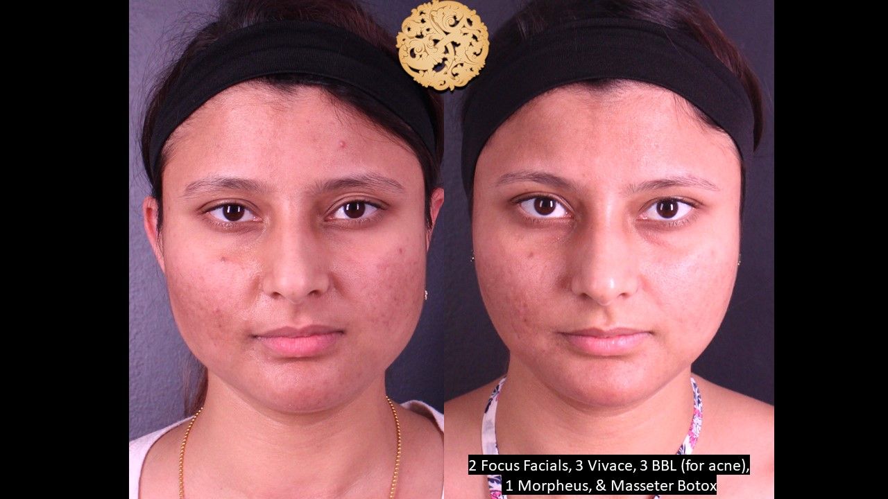 Bbl Laser Acne Before & After