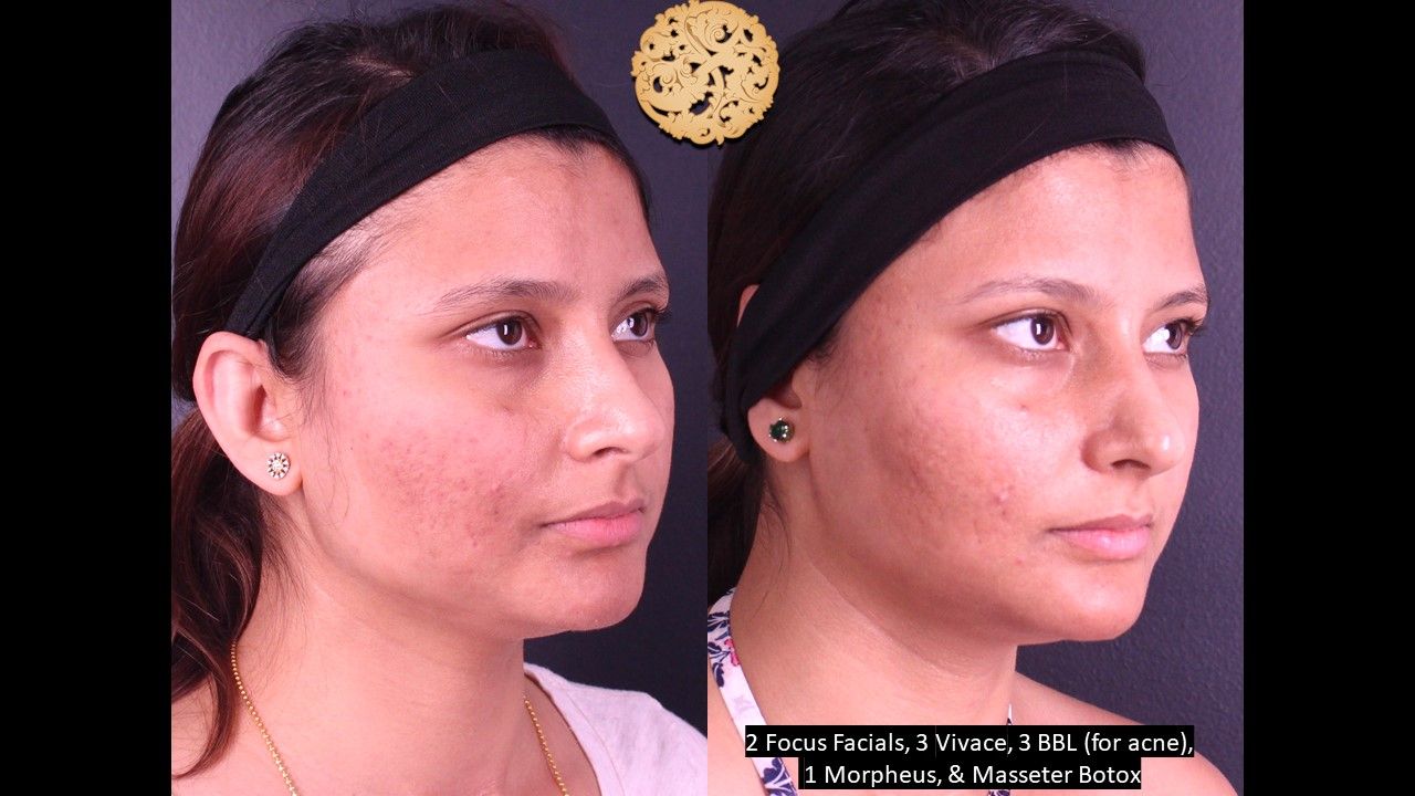 Bbl Laser Acne Before & After