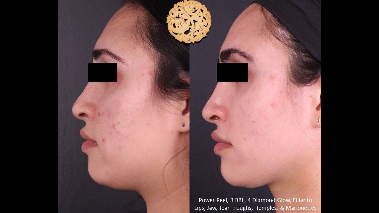 BBL Laser Acne Before & After