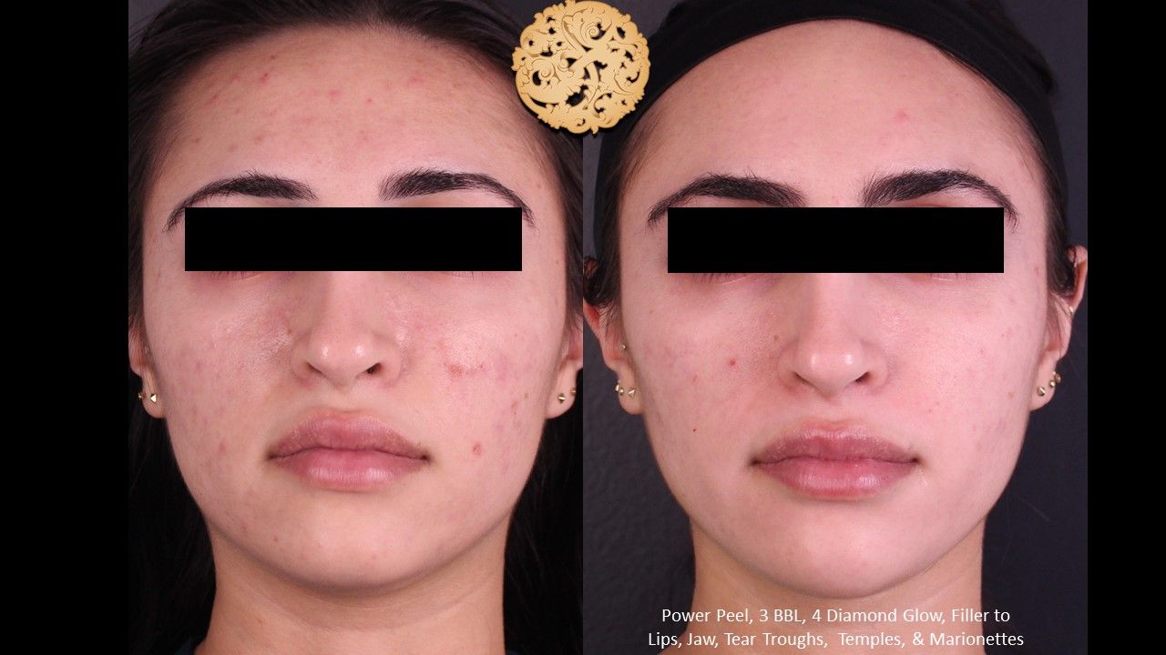 Bbl Laser Acne Before & After