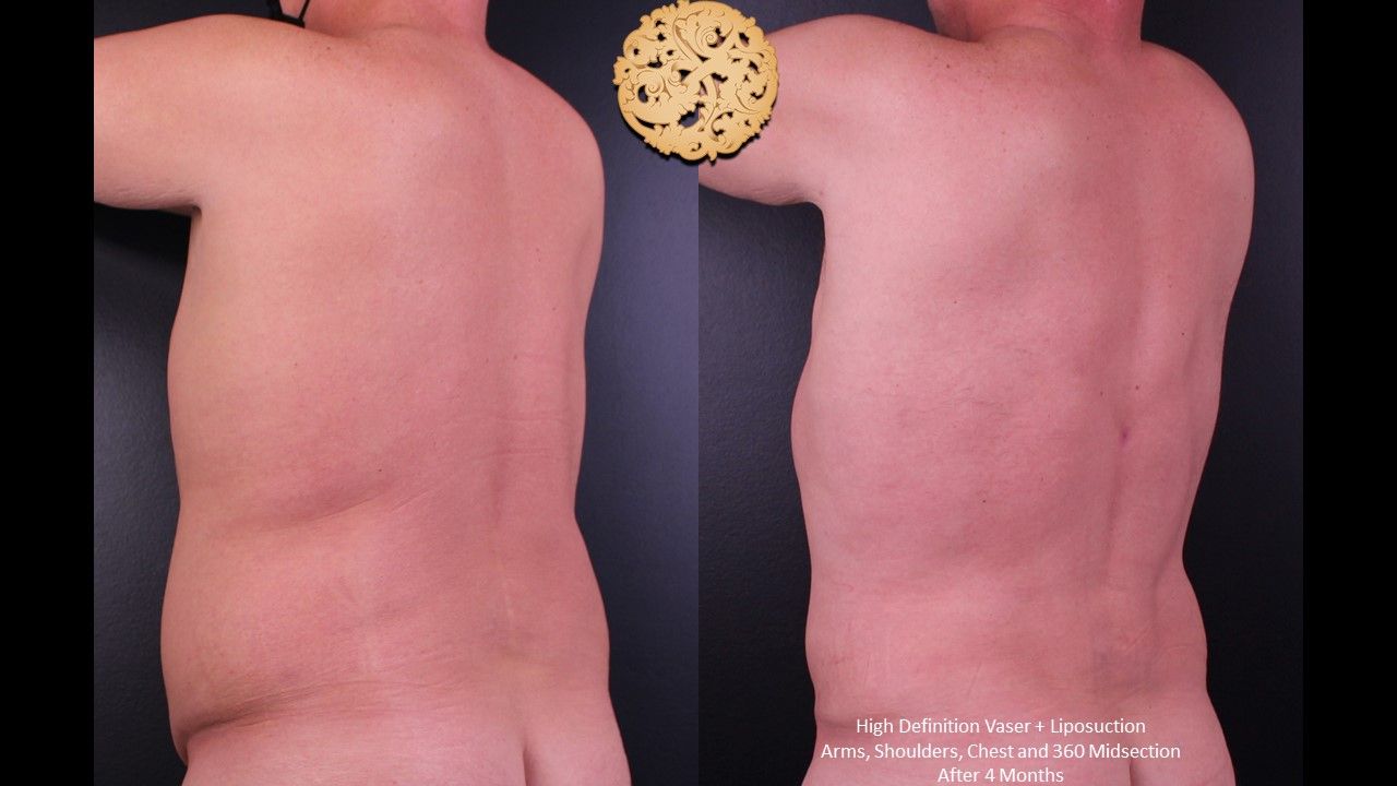 Vaser Before & After