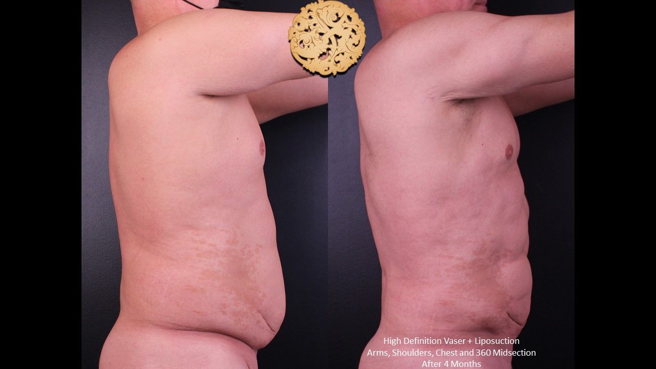 Vaser Before & After