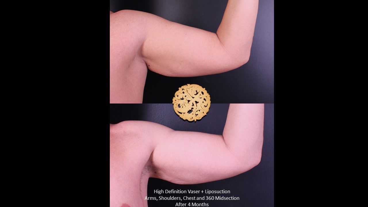 Vaser Before & After