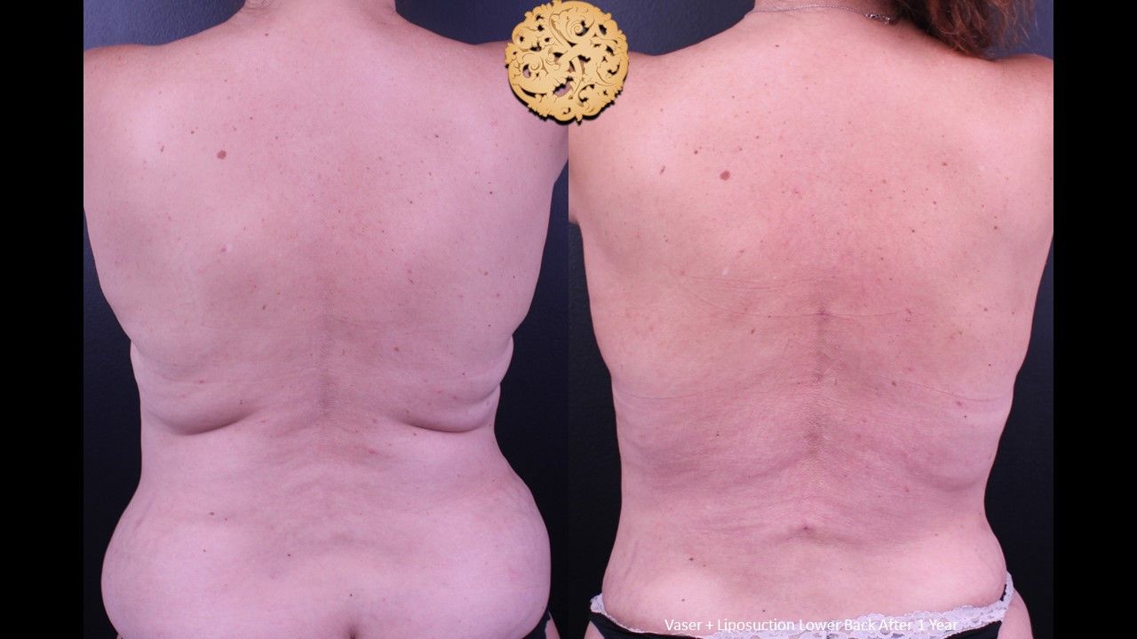 Vaser Before & After