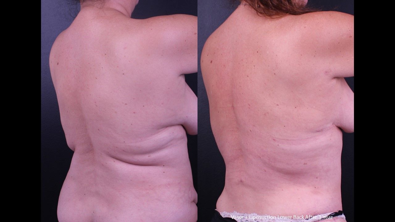 Vaser Before & After