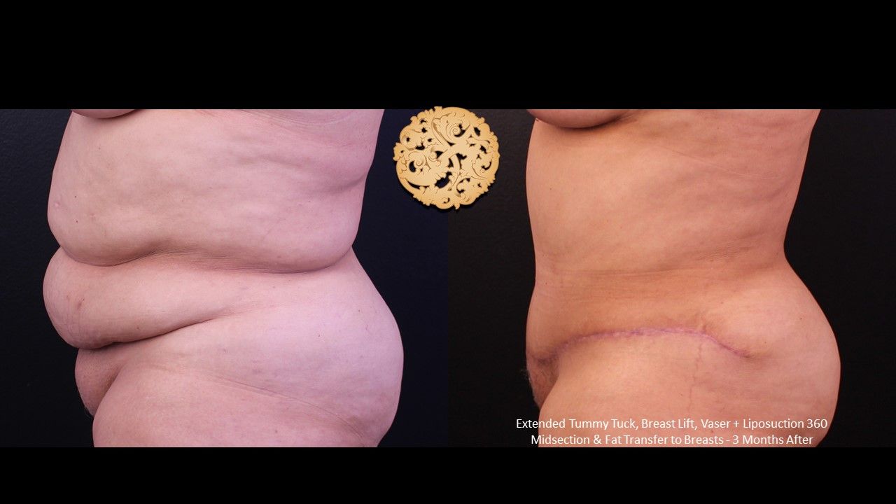 Vaser Before & After