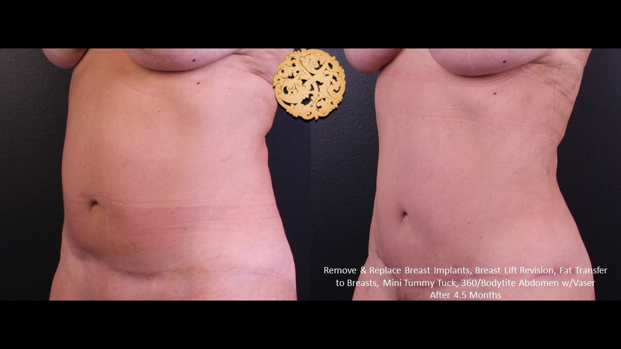 Vaser Before & After