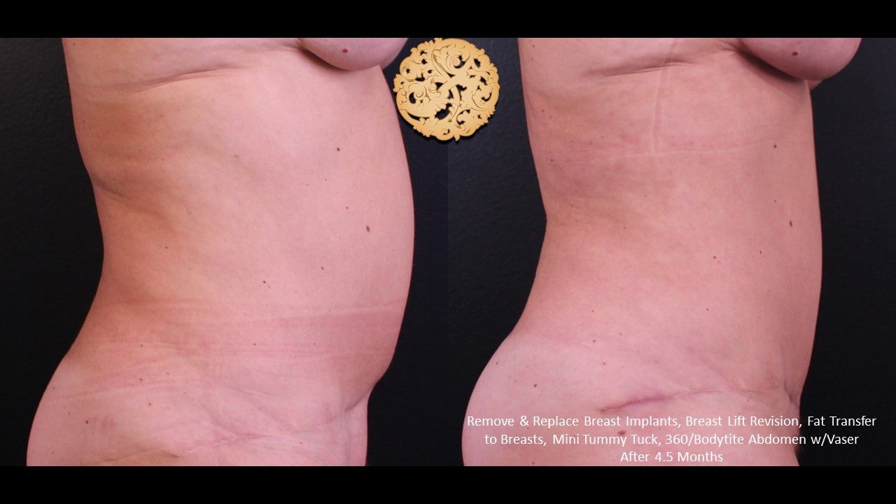 Vaser Before & After