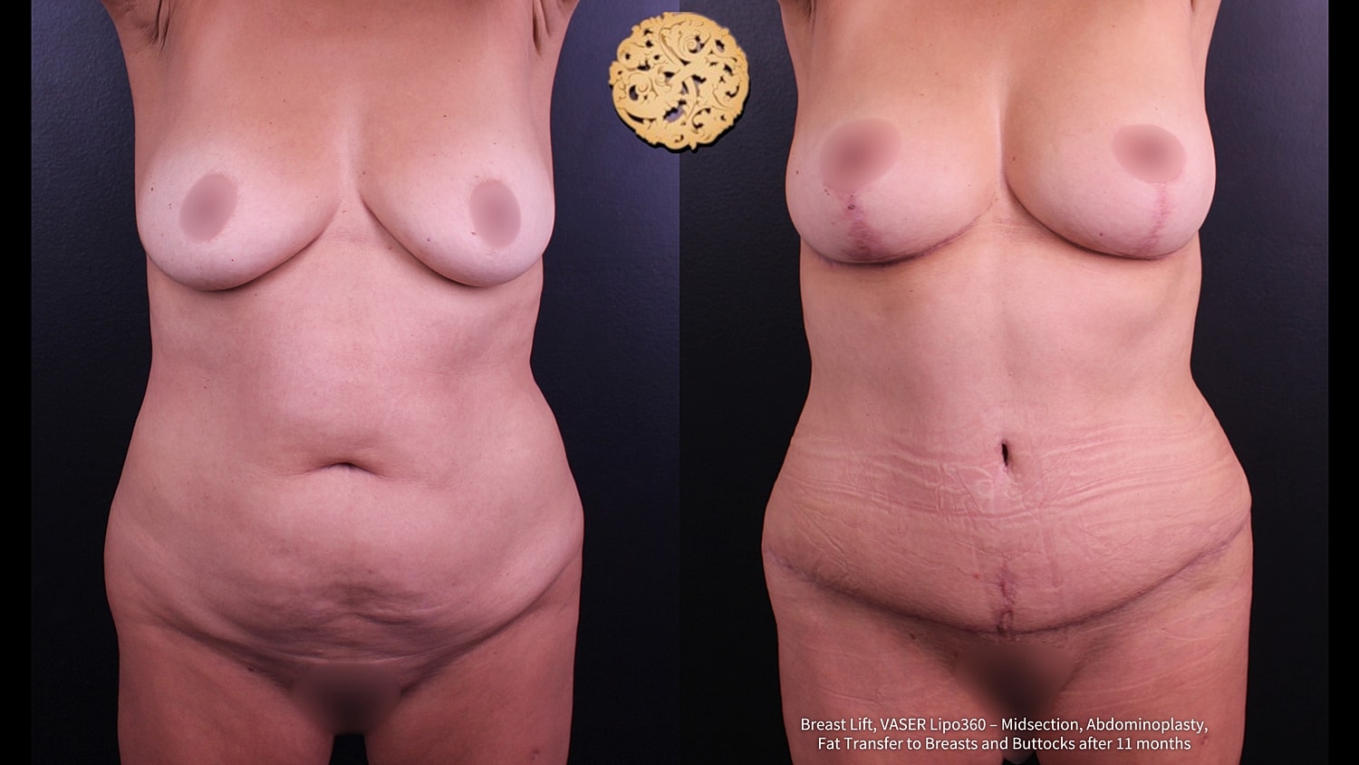 Vaser Before & After