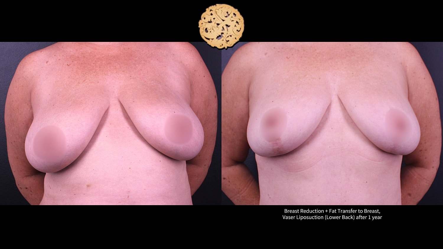 Vaser Before & After