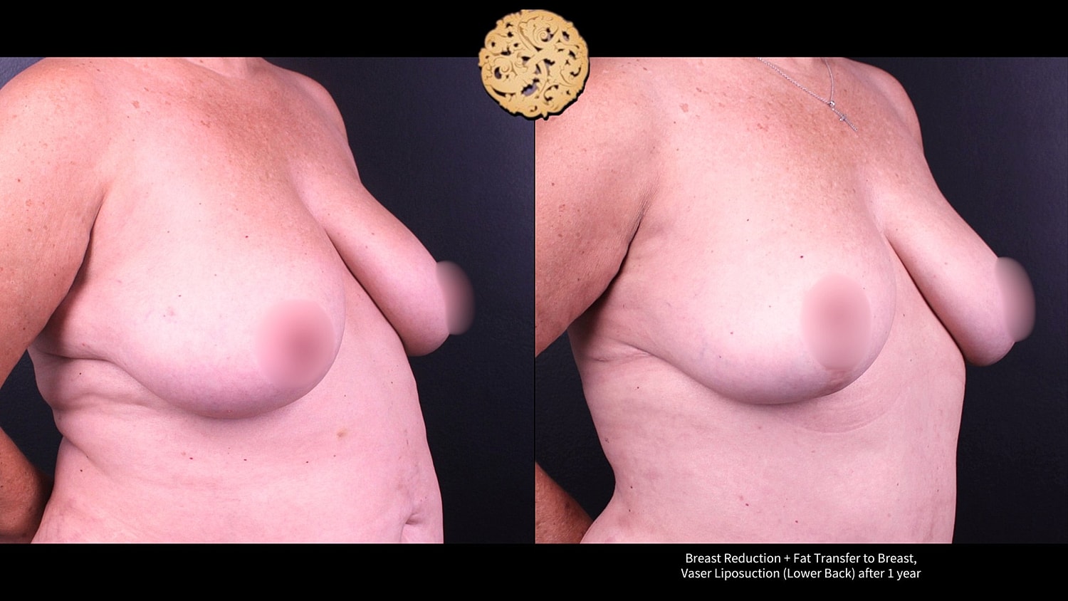 Vaser Before & After