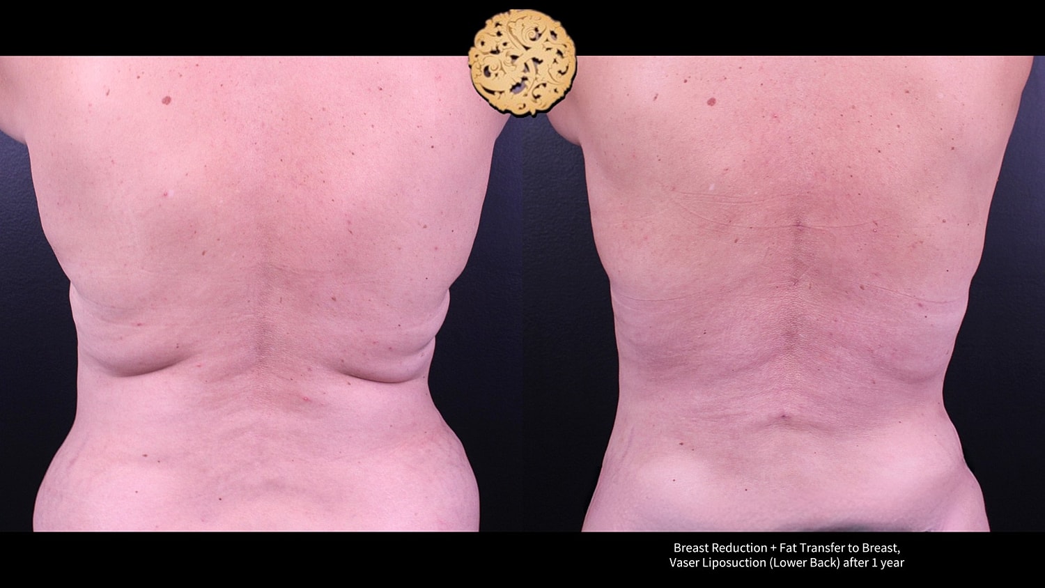 Vaser Before & After