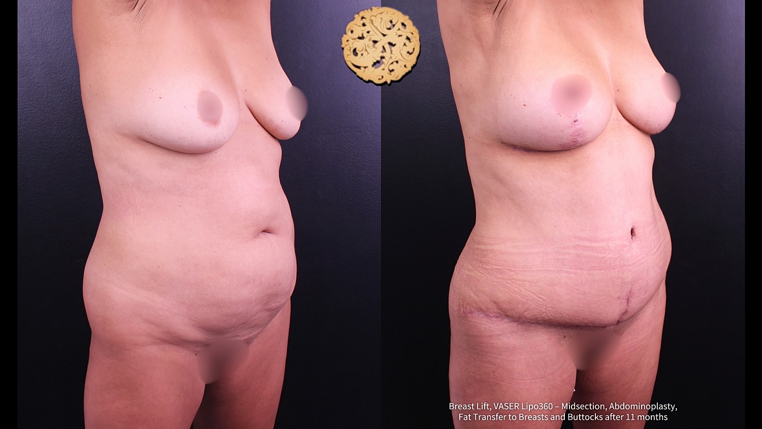 Vaser Before & After
