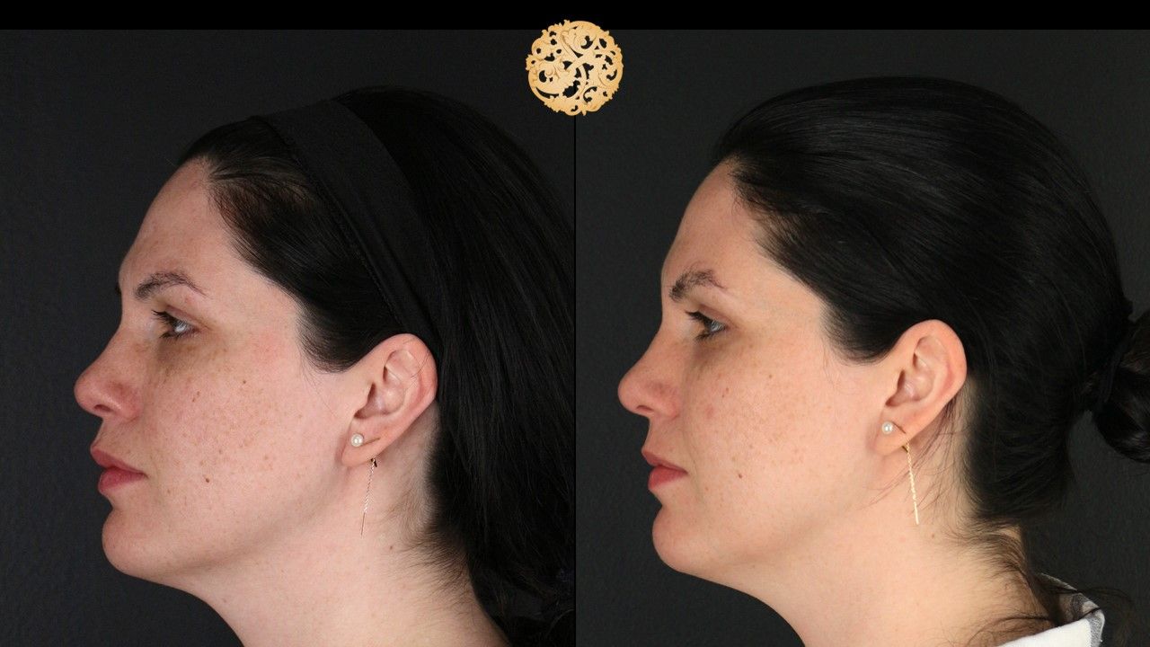 Picosure Laser Resurfacing Before & After