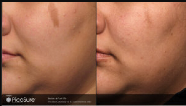 PicoSure Laser Resurfacing Before & After