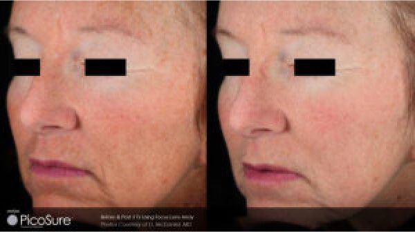 PicoSure Laser Resurfacing Before & After