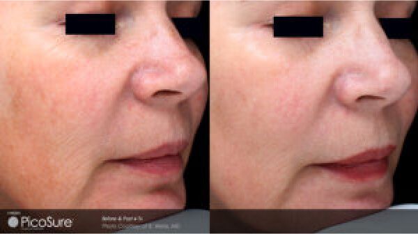 PicoSure Laser Resurfacing Before & After