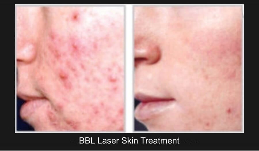 BBL Laser Before & After