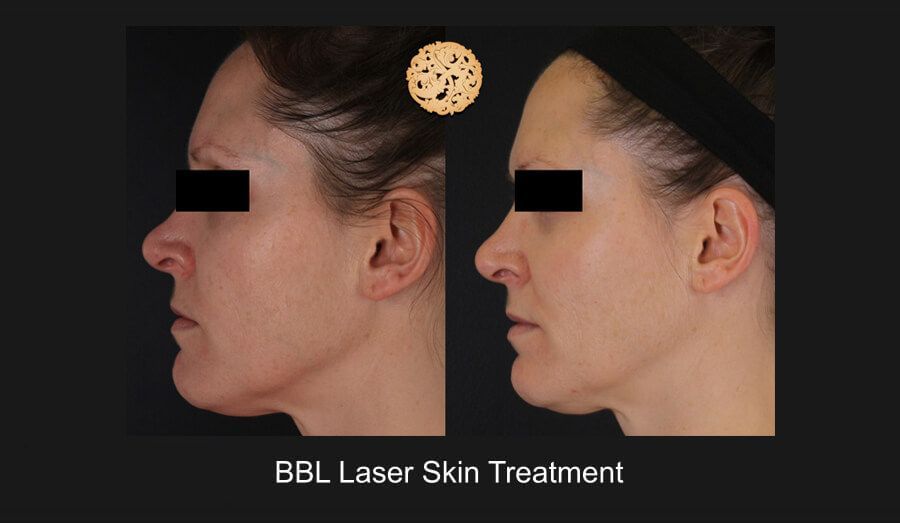 BBL Laser Before & After