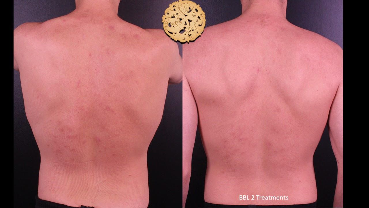 BBL Laser Before & After