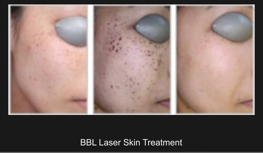 BBL Laser Before & After