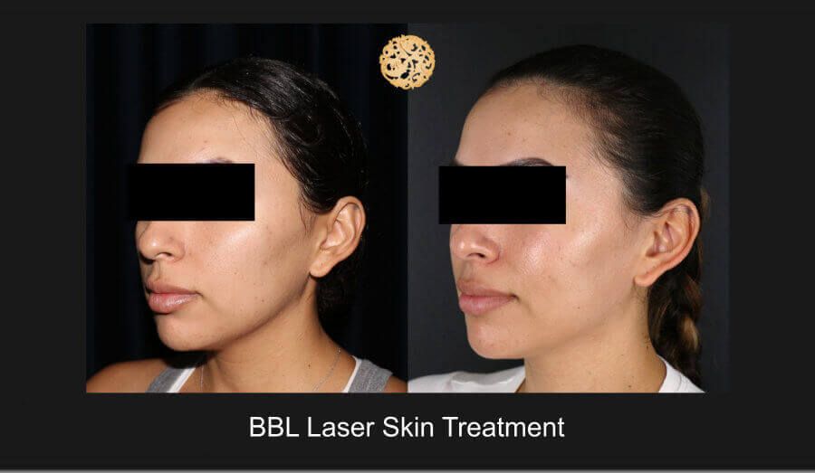 BBL Laser Before & After