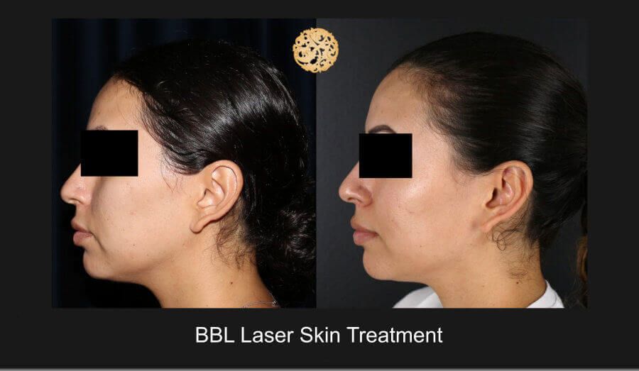 Bbl Laser Before & After