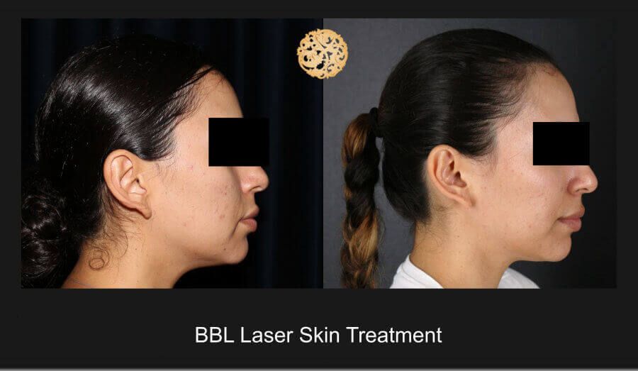 Bbl Laser Before & After